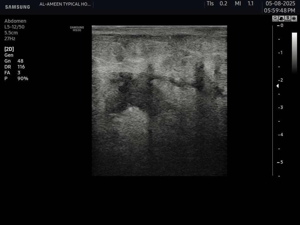 EchoTech_4's tweet image. A 43-year-old female, 5 days post-appendectomy, now presents with purulent discharge from the operative wound. Please comment on the sonographic findings.”

#EchoTech