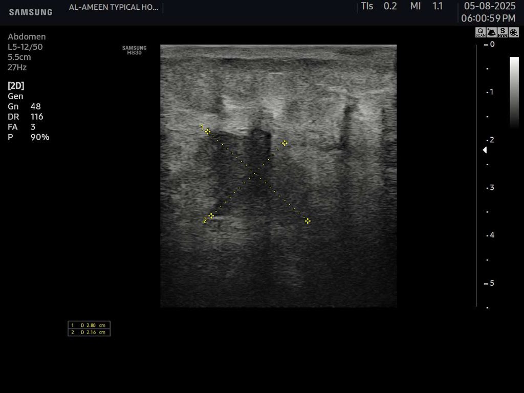 EchoTech_4's tweet image. A 43-year-old female, 5 days post-appendectomy, now presents with purulent discharge from the operative wound. Please comment on the sonographic findings.”

#EchoTech