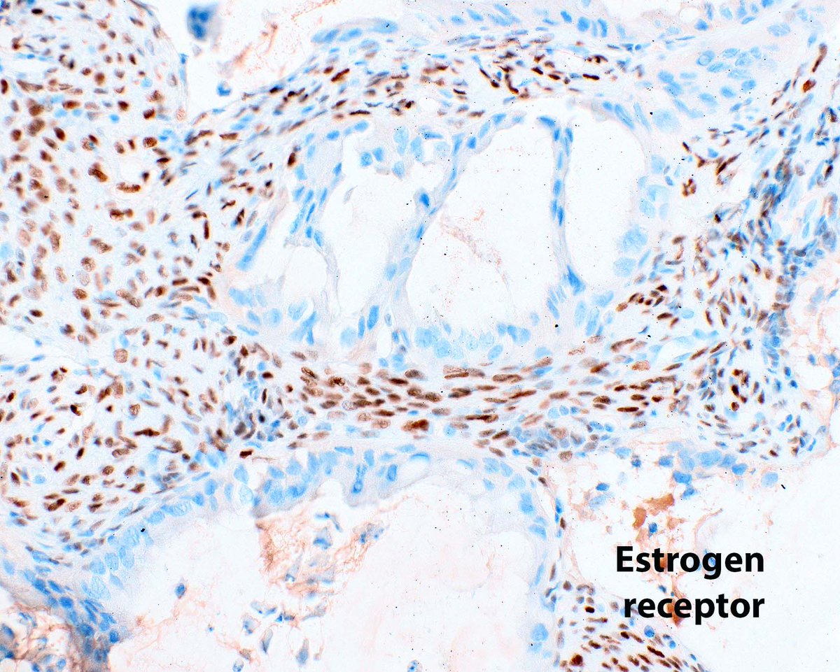 This pancreatic ductal adenocarcinoma spread to the ovary despite negative frozen section margins! Well, duh, the two are unrelated.  Folks, we are wasting time on those stressful frozens for essentially no benefit to patients - read all about it!
Li X, Malik P, Bhalla A,