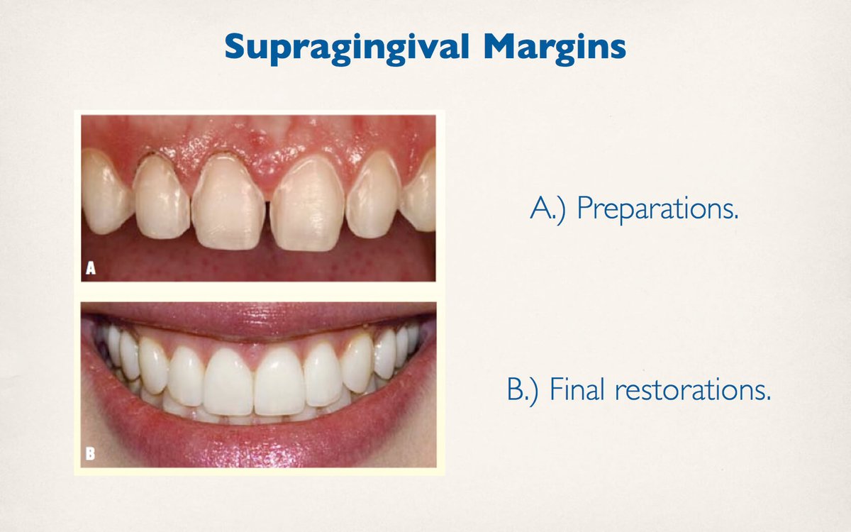What is supragingival?
dentagama.com/news/what-is-s…