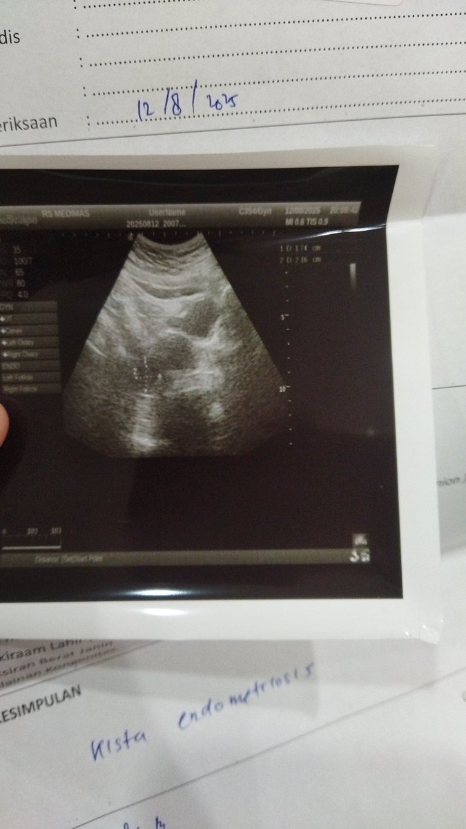 Ibukucinggg's tweet photo. Kista endometriosis 2 cm -
Deg, rasanya campur aduk
Sedih, seperti nggak percaya sama kenyataan pahit yang dialami. Seperti rasanya terus terusan bersalah kepada suami karena bisa jadi aku nggak bisa kasih dia keturunan seperti apa yang selama ini kita harapkan. https://t.co/EVjgaSDBqw