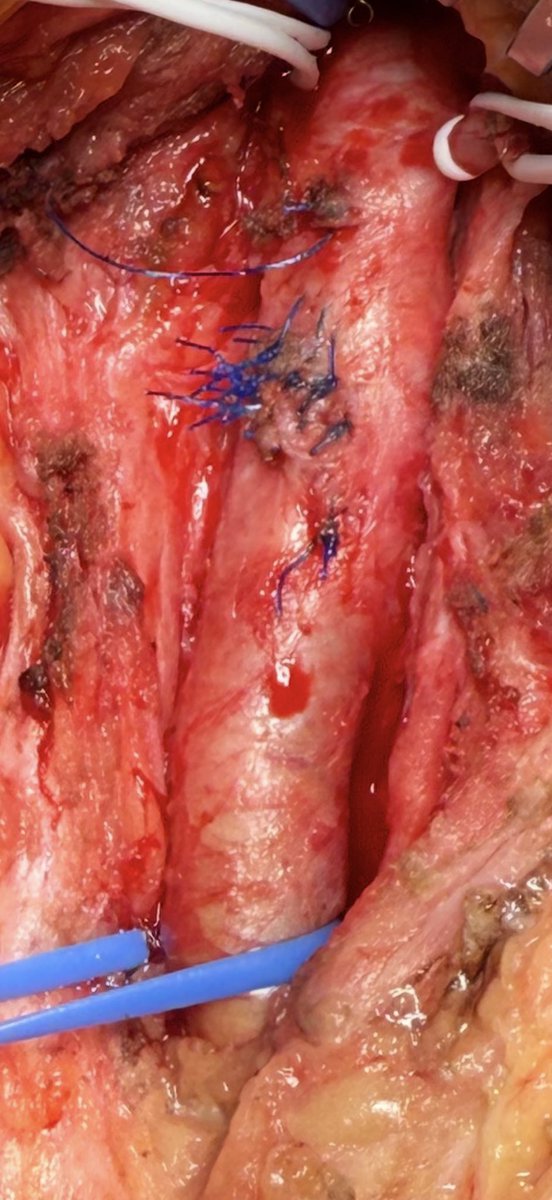 I counted 11 and all of that in a little over  a year.  😳.   #vascular #surgery #endovascular #medtwitter