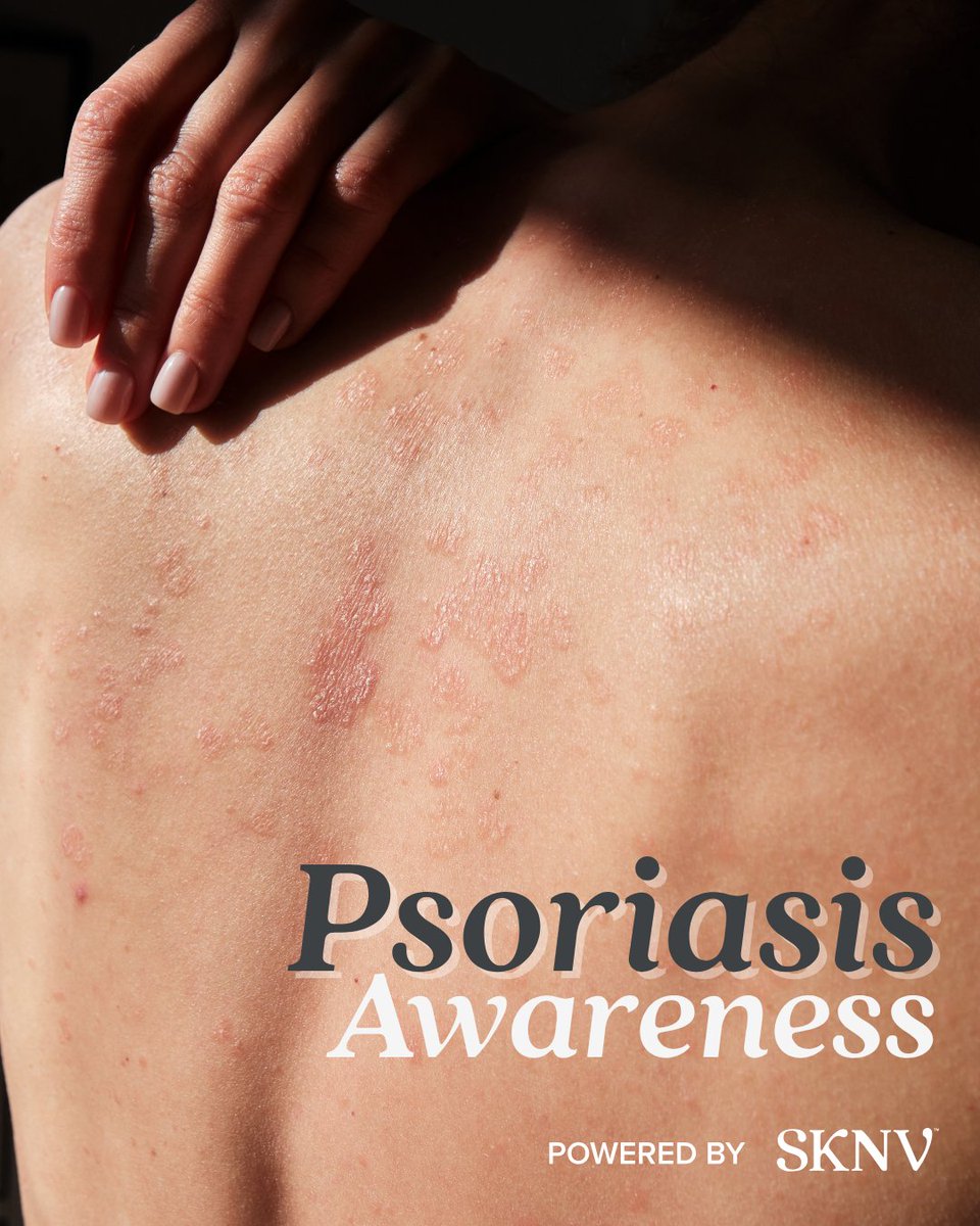Psoriasis is more than just a skin condition—it’s a chronic, immune-related disease that affects millions.

Talk to your provider about personalized options that support your skin’s unique needs.

#PsoriasisAwareness #SKNV #SkinHealthMatters #DermatologySupport #CustomizedRx