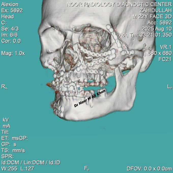 SurgeonMaxillo's tweet photo. Dr. Noor M Ali Khan the delinquent Maxillofacial surgeon that Afghanistan got I haven't witnessed his match across Asia.
#RTA #ORIF. https://t.co/dFbIFcnvQL