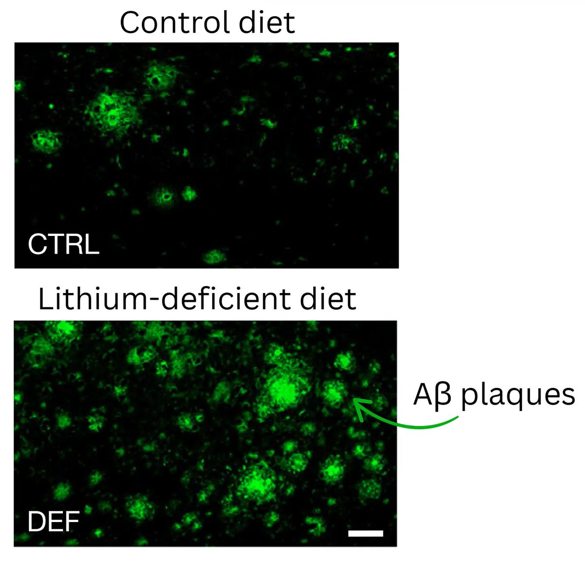 DrSamuelBHume's tweet photo. Top 3 advances in medicine this week (🧵)

1. Low lithium might start the Alzheimer’s cascade

There's a decades-long window to intervene in Alzheimer's before symptoms start, but we still have no (effective) treatments to do this

This study finds low lithium in human brains with very early Alzheimer's, and – in mice – replacing lithium prevented amyloid β buildup and stopped cognitive decline

Lithium has potential as a cheap, widely-available supplement that's upstream of the entire Alzheimer's cascade: human trials needed!

https://t.co/YP5MsHnPkN