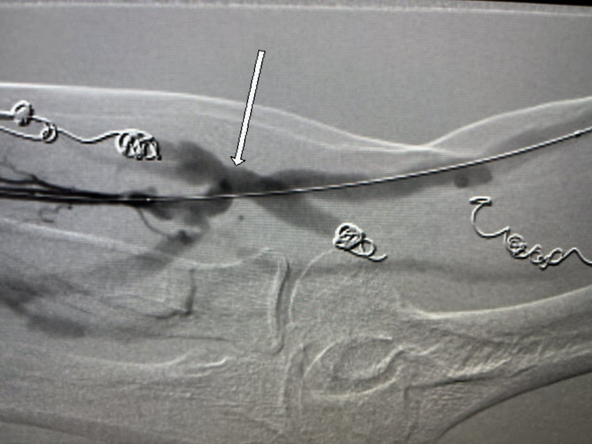 RepkoMd's tweet photo. #FLEXfirst vessel prep catheter for treatment of #endoAVF #Wavelinq stenosis https://t.co/26lrTP93n3