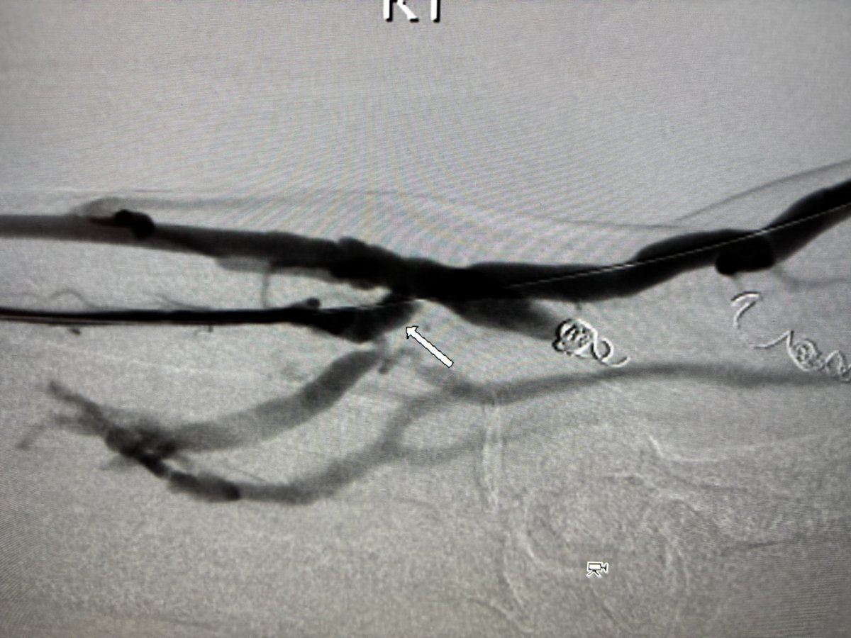 RepkoMd's tweet photo. #FLEXfirst vessel prep catheter for treatment of #endoAVF #Wavelinq stenosis https://t.co/26lrTP93n3