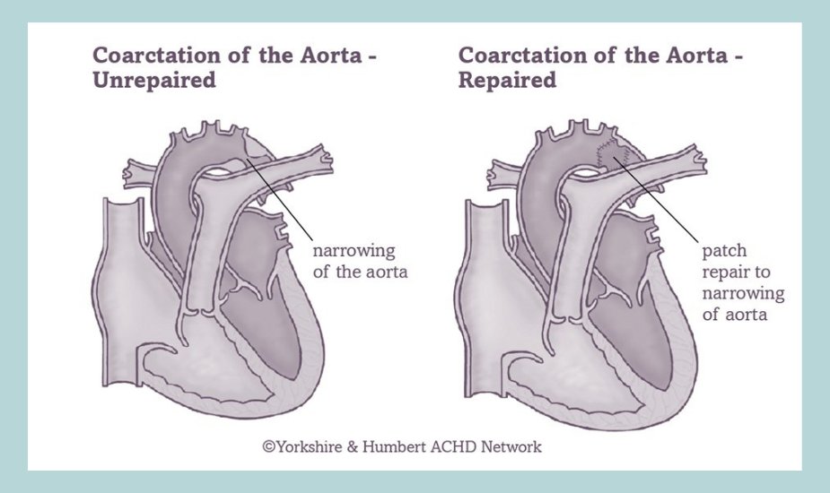 ACHA (@acha_heart) on Twitter photo Living with #CHD or caring for someone with CHD? Our Q&As — like the one on #coarctationoftheaorta — offer trusted answers and support. Explore them all at ow.ly/G3QK50WERKq. #ACHD #CHDAwareness #CHDCare4Life #ACHACares Living with #CHD or caring for someone with CHD? Our Q&As — like the one on #coarctationoftheaorta — offer trusted answers and support. Explore them all at ow.ly/G3QK50WERKq. #ACHD #CHDAwareness #CHDCare4Life #ACHACares