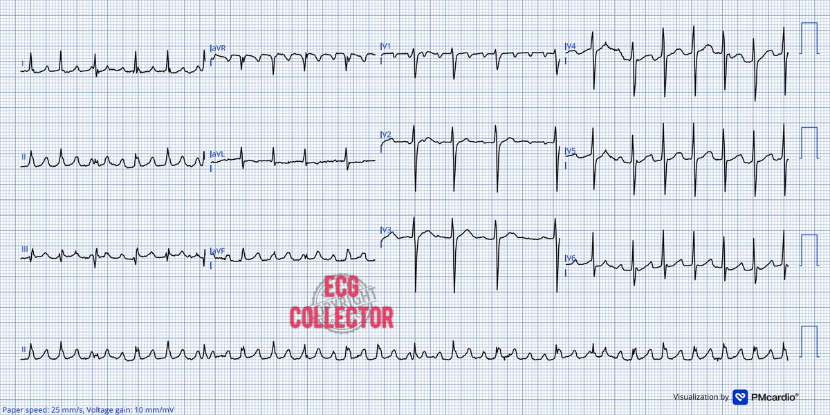 Dr Razi (@drrazi4) on Twitter photo Eldery lady with shortness of breath and fever; Vitals stable;
What is the rhythmš¤ā
<a href="/PMcardioApp/">PMcardioāAI that reads ECGs</a>
#ECG
#CardioTwitter
#CardioEd
#Cardiology
#medicalstudent
#Medtwitter Eldery lady with shortness of breath and fever; Vitals stable;
What is the rhythmš¤ā
<a href="/PMcardioApp/">PMcardioāAI that reads ECGs</a>
#ECG
#CardioTwitter
#CardioEd
#Cardiology
#medicalstudent
#Medtwitter