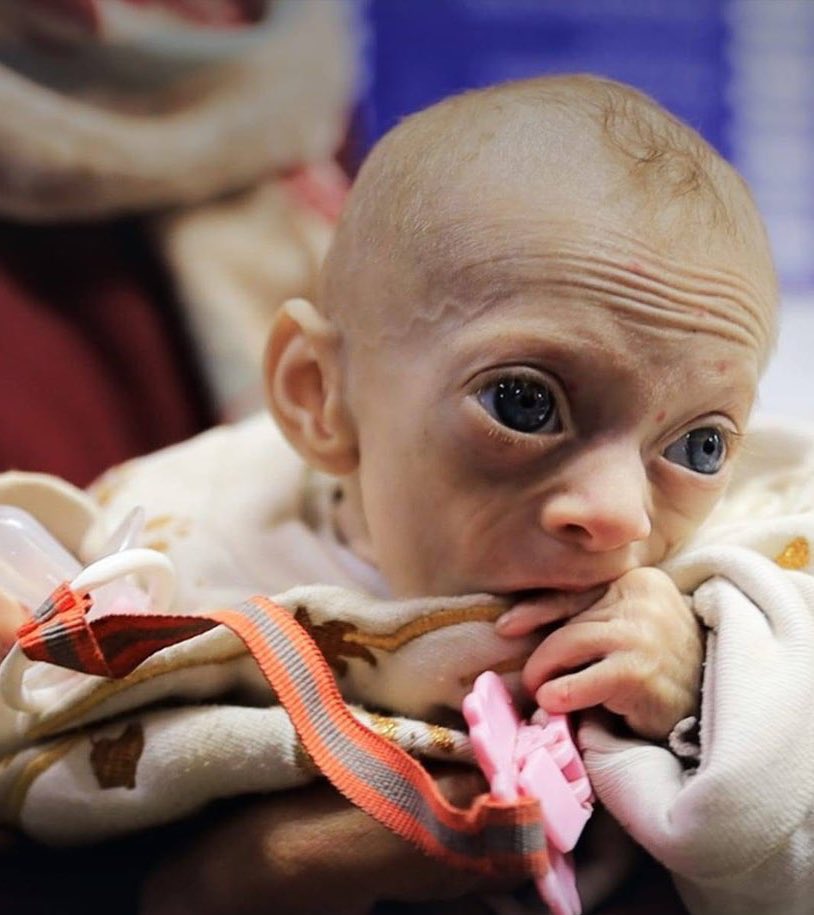 FZ_Ezz's tweet image. #Famine_in_Gaza #stopfamine
#IsraeliTerrorists #IsraelisISIS #Palestine_Genocide #USA #Gaza_Genocide #Gaza_War