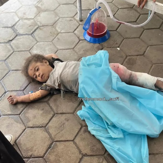 ๐ต๐ธโ๐พ๐ชHanan Al fashg ุญูุงู ุงููุงุดู (@han_moh7) on Twitter photo ุงู
ู ุงูุฎุฐูุงู ูุงูุนุงุฑ ุฃูู ุงูุชู
๐๐๐ป
ุทููุฉ ู
ุตุงุจุฉ ุจุฌุฑูุญ ุฎุทูุฑุฉ ุชูุชุฑุด ุงูุฃุฑุถ ู
ุน ุชูุฏุณ ุงูุฅุตุงุจุงุช ูููุฉ ุงูุฅู
ูุงูุงุช ุงูุทุจูุฉุ ุจุนุฏ ุฃู ููุฏุช ุนุงุฆูุชูุง ูู ูู ูุตู ููู ููุงุญู ูุชูุงู ุนูู ู
ุฏููุฉ ุบุฒุฉ.๐ฑ๐ญ
ูุง ุชุชุฌุงูู ๐ฅบ๐ฅบ ู
ู ุฃุฌู ุงูุฅูุณุงููุฉ ูุง ุชุชููู ุนู ุงููุดุฑ๐ูุงูู
ุดุงุฑูุฉ๐ต๐ธ
#ูู_ุบุฒุฉ_ูุชูุช_ุงูุทูููุฉ
#ุฎุฐูุงู_ุบุฒุฉ_ุฌุฑูู
ุฉ ุงู
ู ุงูุฎุฐูุงู ูุงูุนุงุฑ ุฃูู ุงูุชู
๐๐๐ป
ุทููุฉ ู
ุตุงุจุฉ ุจุฌุฑูุญ ุฎุทูุฑุฉ ุชูุชุฑุด ุงูุฃุฑุถ ู
ุน ุชูุฏุณ ุงูุฅุตุงุจุงุช ูููุฉ ุงูุฅู
ูุงูุงุช ุงูุทุจูุฉุ ุจุนุฏ ุฃู ููุฏุช ุนุงุฆูุชูุง ูู ูู ูุตู ููู ููุงุญู ูุชูุงู ุนูู ู
ุฏููุฉ ุบุฒุฉ.๐ฑ๐ญ
ูุง ุชุชุฌุงูู ๐ฅบ๐ฅบ ู
ู ุฃุฌู ุงูุฅูุณุงููุฉ ูุง ุชุชููู ุนู ุงููุดุฑ๐ูุงูู
ุดุงุฑูุฉ๐ต๐ธ
#ูู_ุบุฒุฉ_ูุชูุช_ุงูุทูููุฉ
#ุฎุฐูุงู_ุบุฒุฉ_ุฌุฑูู
ุฉ