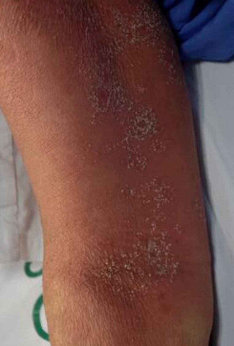 DermMarianne's tweet photo. Acute generalized exanthematous pustulosis in 1⃣ tweet:
💊Drug-induced type IV hypersensitivity reaction
👀Sterile pustules on erythema, starting in intertriginous areas + fever
📅Latency: ~3 days; self-limited in ~2 weeks
💊Most linked: diltiazem
💉Tx: topical/systemic CS https://t.co/D9gtQAbB0m