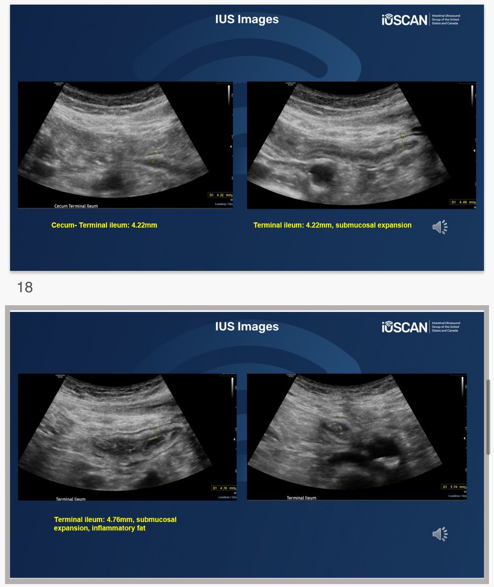 Jami Kinnucan, MD, FACG, AGAF, FCCF (@ibdgijami) on Twitter photo So proud of the work that our advanced #IBD fellow <a href="/passisd/">Passisd Laoveeravat</a> has done with #IUS in just 4 weeks since starting at <a href="/MayoClinicFLGIH/">Mayo Clinic Florida Gastroenterology & Hepatology</a>
Presenting at <a href="/iUSCAN/">iUSCAN</a> monthly international #IUS conference on a recent case
Point of care testing POC #IUS changing treatment plans real time So proud of the work that our advanced #IBD fellow <a href="/passisd/">Passisd Laoveeravat</a> has done with #IUS in just 4 weeks since starting at <a href="/MayoClinicFLGIH/">Mayo Clinic Florida Gastroenterology & Hepatology</a>
Presenting at <a href="/iUSCAN/">iUSCAN</a> monthly international #IUS conference on a recent case
Point of care testing POC #IUS changing treatment plans real time