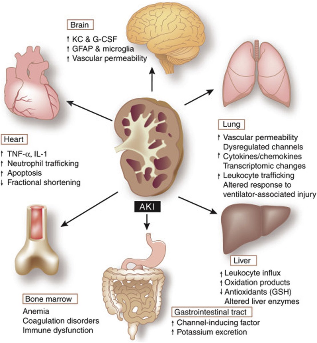 Acute Kidney Injury (AKI) is a sudden and significant decline in kidney function that can lead to systemic effects and impact the function of various distant organs through complex interactions known as "organ crosstalk". 

The image illustrates these widespread effects of AKI:
