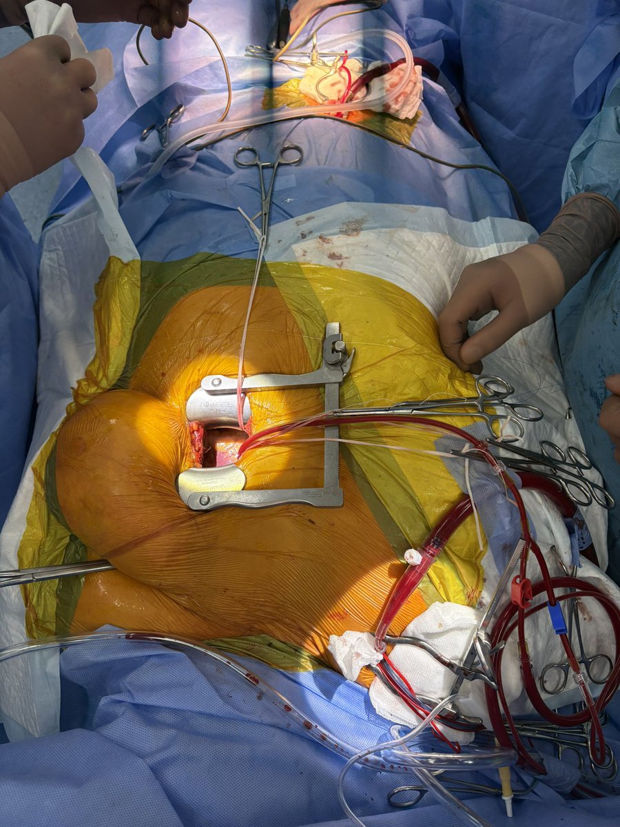 BabliakD's tweet image. This is what TCRAT-CABG + mitral valve repair looks like in a female patient via left anterior thoracotomy — using axillary artery cannulation.

Minimally invasive, multi-component approach in action.

#TCRAT #CABG #MICS #mitralvalve #cardiacsurgery #thoracotomy #axillary