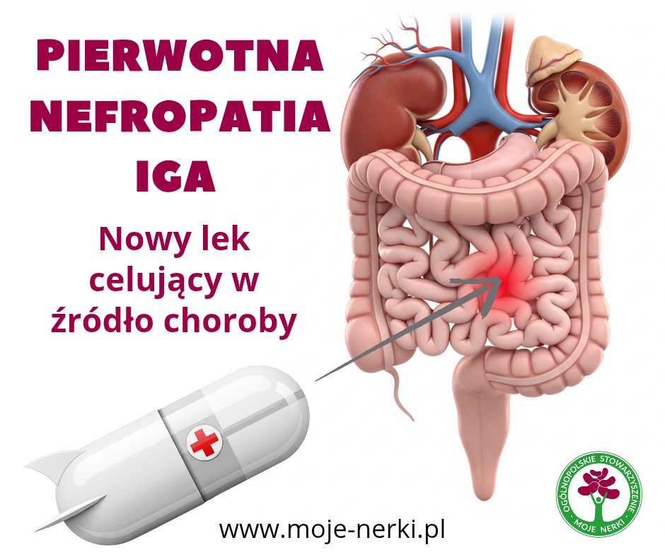 Ogólnopolskie Stowarzyszenie Moje Nerki (@moje_nerki_pl) on Twitter photo 📢W PL refundowany jest już lek budezonid o zmodyfikowanym uwalnianiu dla chorych na nefropatię IgA w programie B.171. Szukaj ośrodków realizujących
program w <a href="/NFZ_GOV_PL/">Narodowy Fundusz Zdrowia</a>. ❤️🫘Szansa na dłuższe życie z własnymi nerkami
Więcej: moje-nerki.pl/pierwotna-nefr…
#nefropatialgA #ProgramB171 📢W PL refundowany jest już lek budezonid o zmodyfikowanym uwalnianiu dla chorych na nefropatię IgA w programie B.171. Szukaj ośrodków realizujących
program w <a href="/NFZ_GOV_PL/">Narodowy Fundusz Zdrowia</a>. ❤️🫘Szansa na dłuższe życie z własnymi nerkami
Więcej: moje-nerki.pl/pierwotna-nefr…
#nefropatialgA #ProgramB171