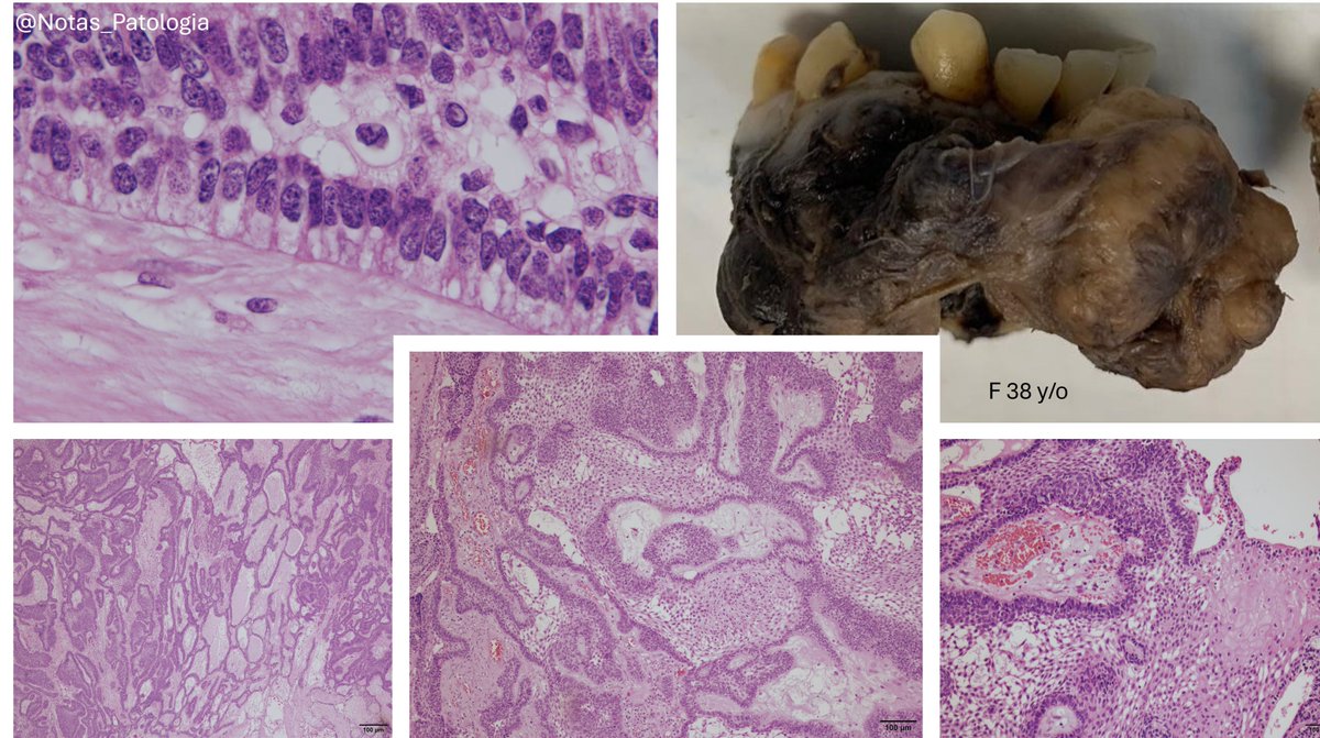 🦷 Conventional Ameloblastoma

📖 Definition

Ameloblastoma (AM) is a benign but locally infiltrative epithelial odontogenic neoplasm affecting the jawbones. It is characterized by the presence of ameloblast-like cells and stellate reticulum, and it may present expansive and