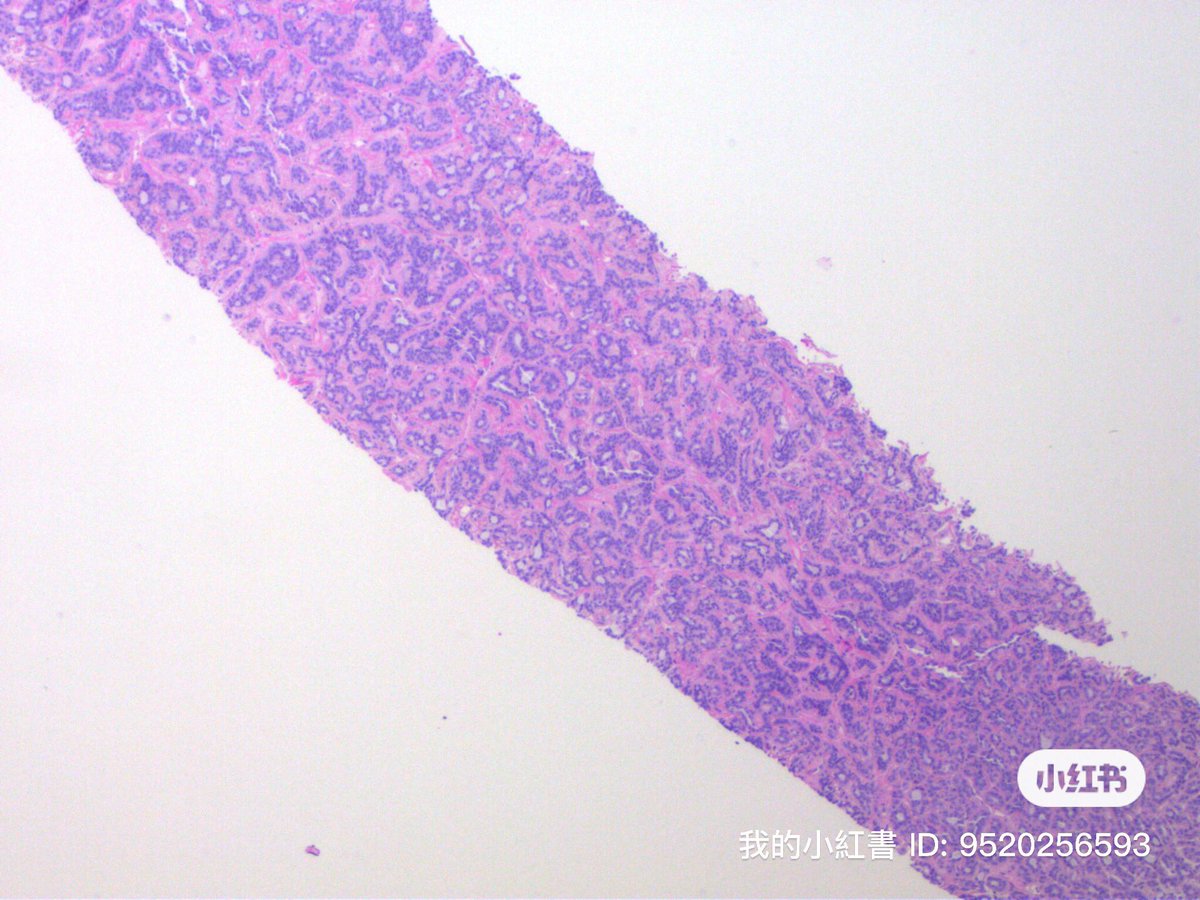 Simon_Path's tweet photo. 55M，2.3cm parotid mass https://t.co/qLn9JluhlB