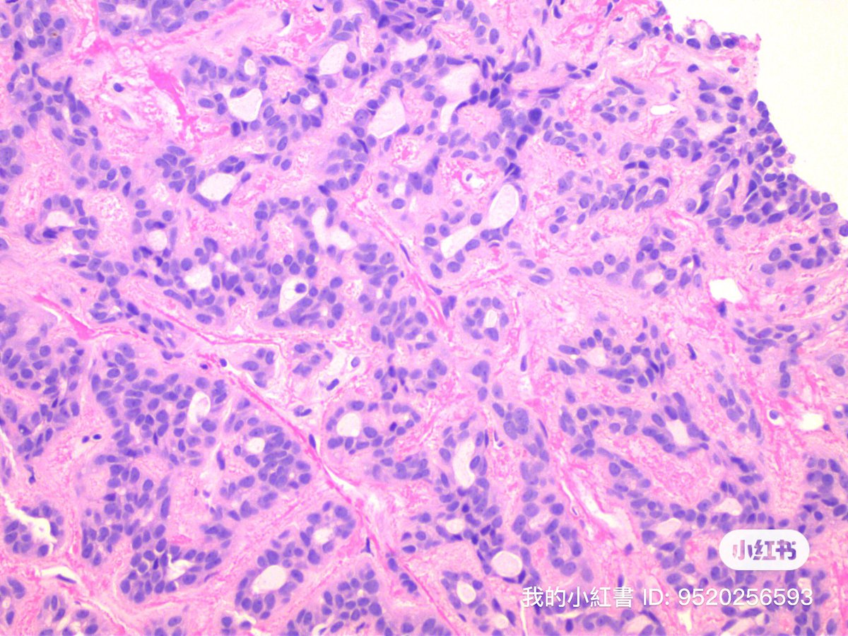 Simon_Path's tweet photo. 55M，2.3cm parotid mass https://t.co/qLn9JluhlB