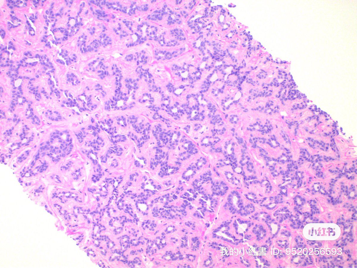 Simon_Path's tweet photo. 55M，2.3cm parotid mass https://t.co/qLn9JluhlB