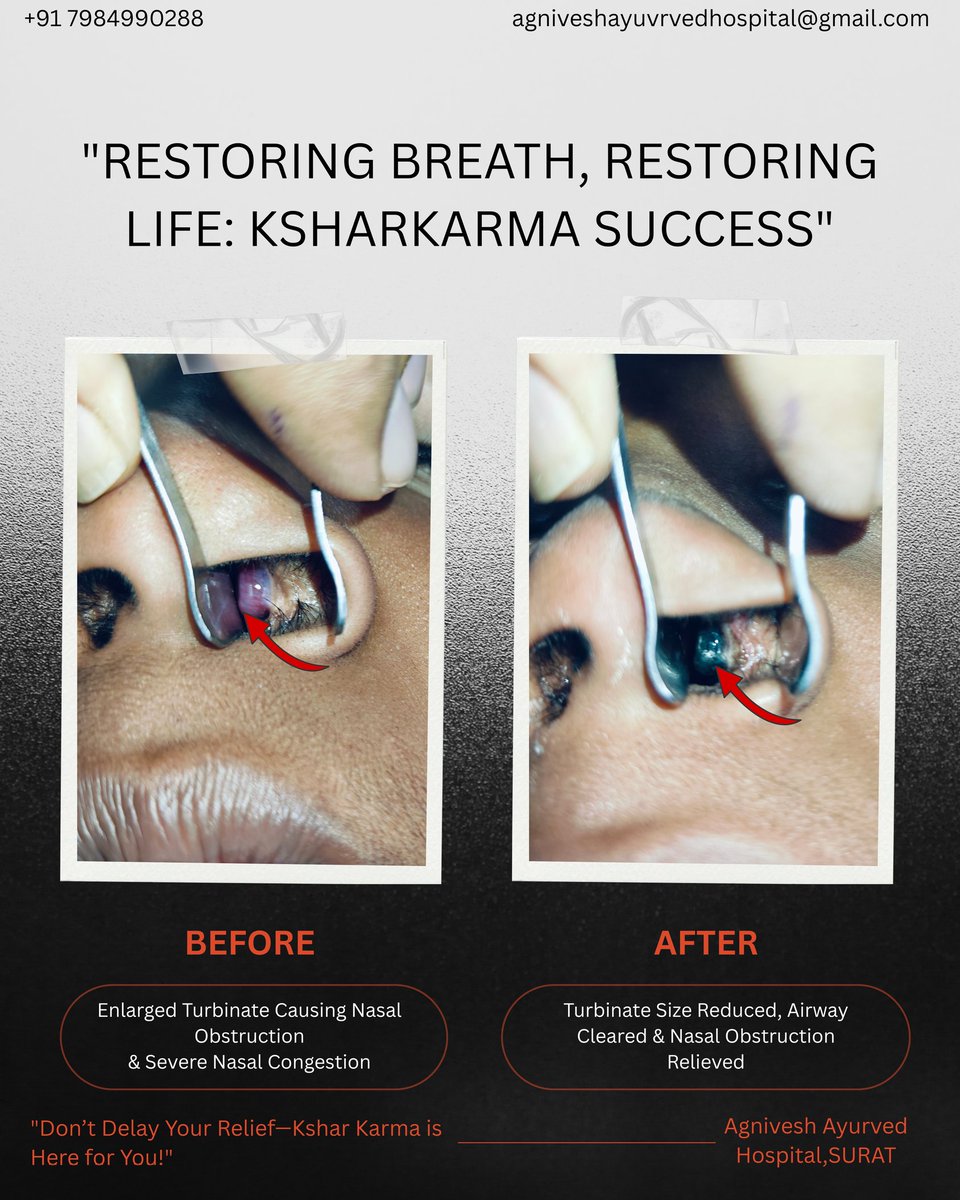 Hypertrophied Nasal turbinates can be treated with Ayurvedic treatment without requiring Surgery...

Don't waste money on surgery where there is a high reoccurrence rate like Hypertrophied nasal turbinates which can be easily treated in less than 5% of the cost of surgery.
