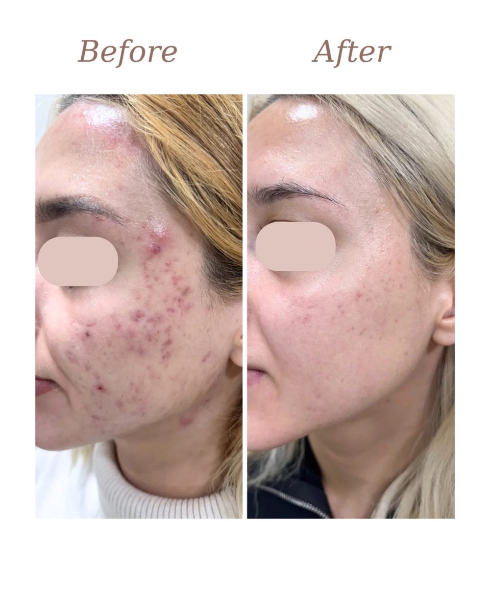 CandelaMedical1's tweet image. Just 2 sessions with the Nordlys®, in the expert hands of Dr. Ioana Pescaru, delivered this remarkable skin improvement.
Nordlys® treatments were paired with carefully prescribed home care, resulting in visible improvements to both active breakouts and post-acne pigmentation!