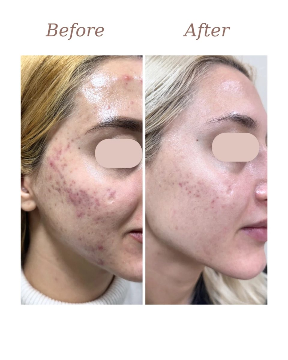 CandelaMedical1's tweet image. Just 2 sessions with the Nordlys®, in the expert hands of Dr. Ioana Pescaru, delivered this remarkable skin improvement.
Nordlys® treatments were paired with carefully prescribed home care, resulting in visible improvements to both active breakouts and post-acne pigmentation!