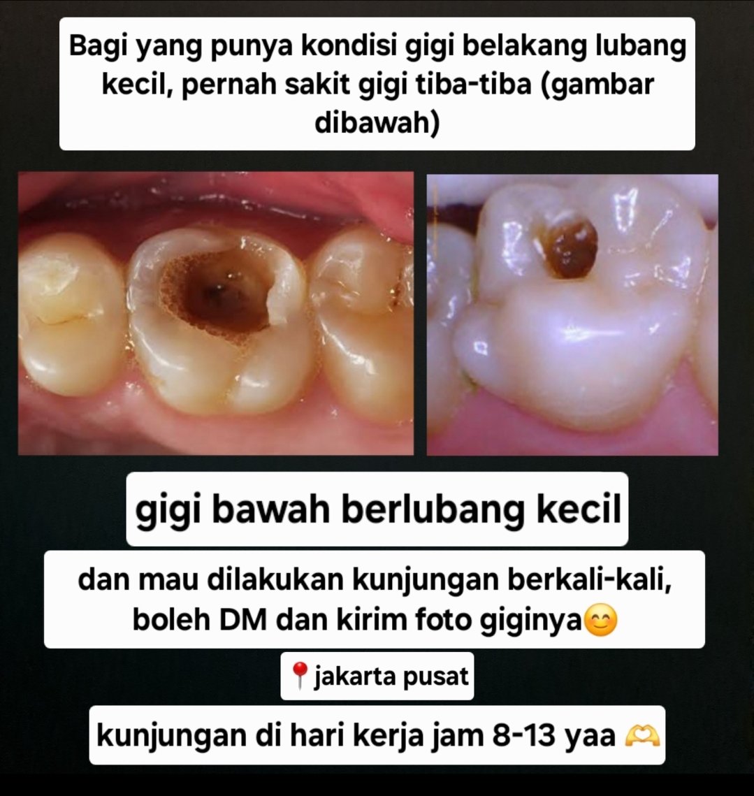 arisuuww's tweet photo. Hii gaiss!!

Masih dicari yg gigi bawah belakang berlubang kecil, suka sakit tiba2, yg mau dirawat akar, bisa kunjungan berkali2, boleh banget dm ya!
Kunjungannya hari kerjaa jam 8-13 yap🤗
📍domisili: jakarta pusat
#sakitgigi 
#psa #rawatakar #koasgigijakarta #gigiberlubang https://t.co/XqG5VLiwKY