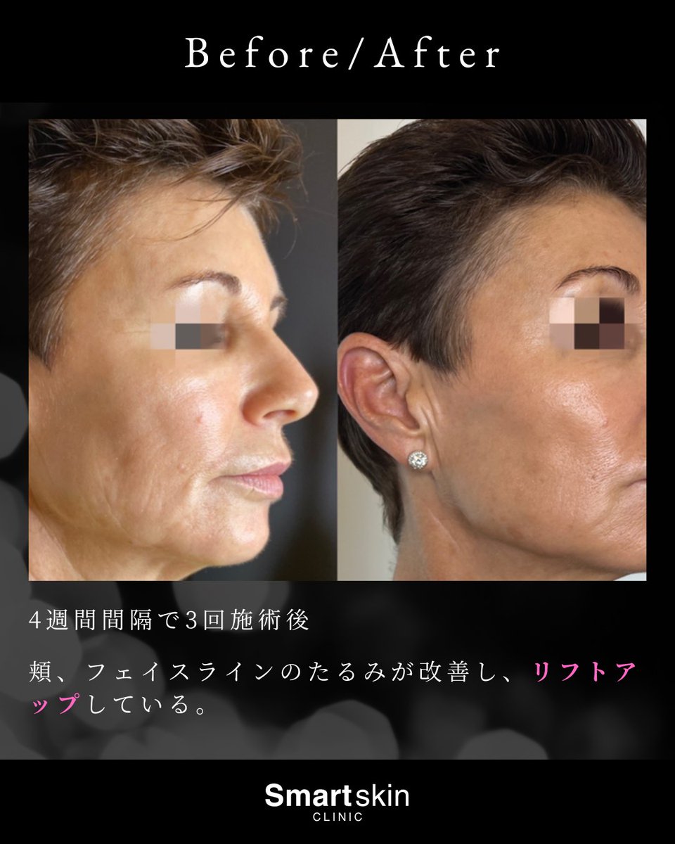 smaskiclinic's tweet photo. 顔のたるみにゴウリ（GOURI）注射という選択肢を。

糸リフトに使用されるPCLを液状化した珍しい製剤。