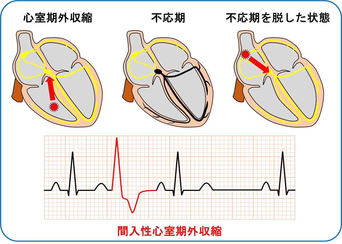 間入性心室期外収縮は心室性期外収縮の一種であり、「間入性」という文字が表すように、洞調律の基本周期の間に心室期外収縮が入り込んだものを指します。