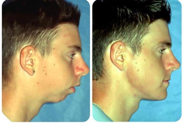 AlshammariOMFS's tweet photo. سلسلة تغريدات عن..
جراحة الفكين التقويمية
{Orthognathic Surgery} 

التي تعمل على تصحيح عدم انتظام عظام الفكين، ... https://t.co/RCW22GkrTJ