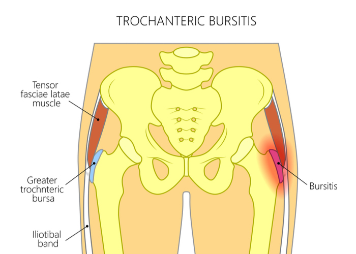 DrJeffPadalecki's tweet photo. #Trochanteric #Bursitis: When the bursa between your thigh bone’s greater trochanter &amp; #ITband gets inflamed, hip pain follows. Common in aging or active runners, bikers &amp; walkers. Learn more 👉 https://t.co/CxYmXdBgqs #hippain #hipinjury #hiphealth https://t.co/akN6GKw6pi