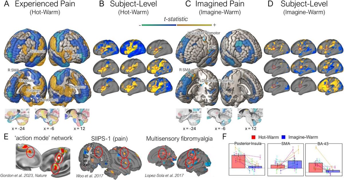 Psychnology's tweet photo. Check out our new preprint on brain activity when experiencing vs. imagining pain (being burned): https://t.co/YzKXaH5frt

Much credit to @torwager @bogpetre @Boke89707488 https://t.co/om1rSdOb8z