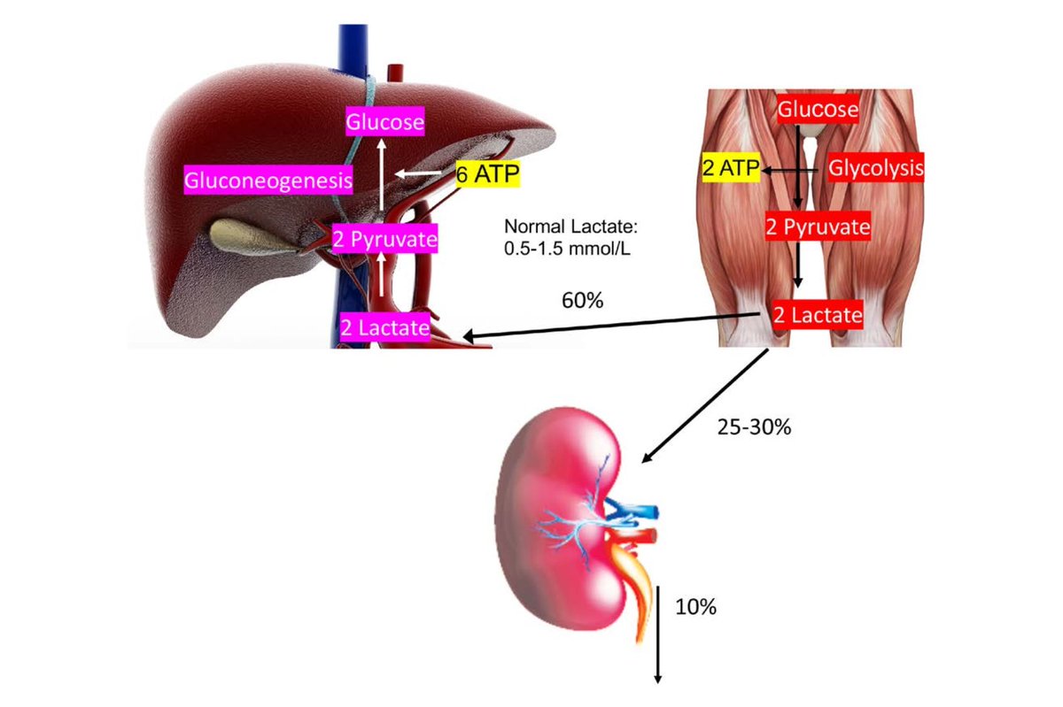 FcoAyusoMC's tweet photo. #Lactato 
Producción:0.8 mm/kg/día.
Eliminación.
-60% :Hepático.
-20% :Renal.
10% Reutilizable en ciclo de cori. (Lactato -->piruvato).

-Hiperlactatemia:Lactato > 2.0 mol/l.
-Acidosis Láctica: Lactato > 2.0 mol/l, más disenso de pH.

Tipos de acidosis láctica.
Tipo A: alteración DO2/V02.
Tipo B: No relacionados con hipoxemia.
B1: enfermedades de base.
B2: Tóxicos o fármacos.
B3: Errores innatos de los metabolismos (congénitos)

Descarga: ⬇️⬇️⬇️
https://t.co/3QwyYX6HOa
https://t.co/T5yV9uIU1Z