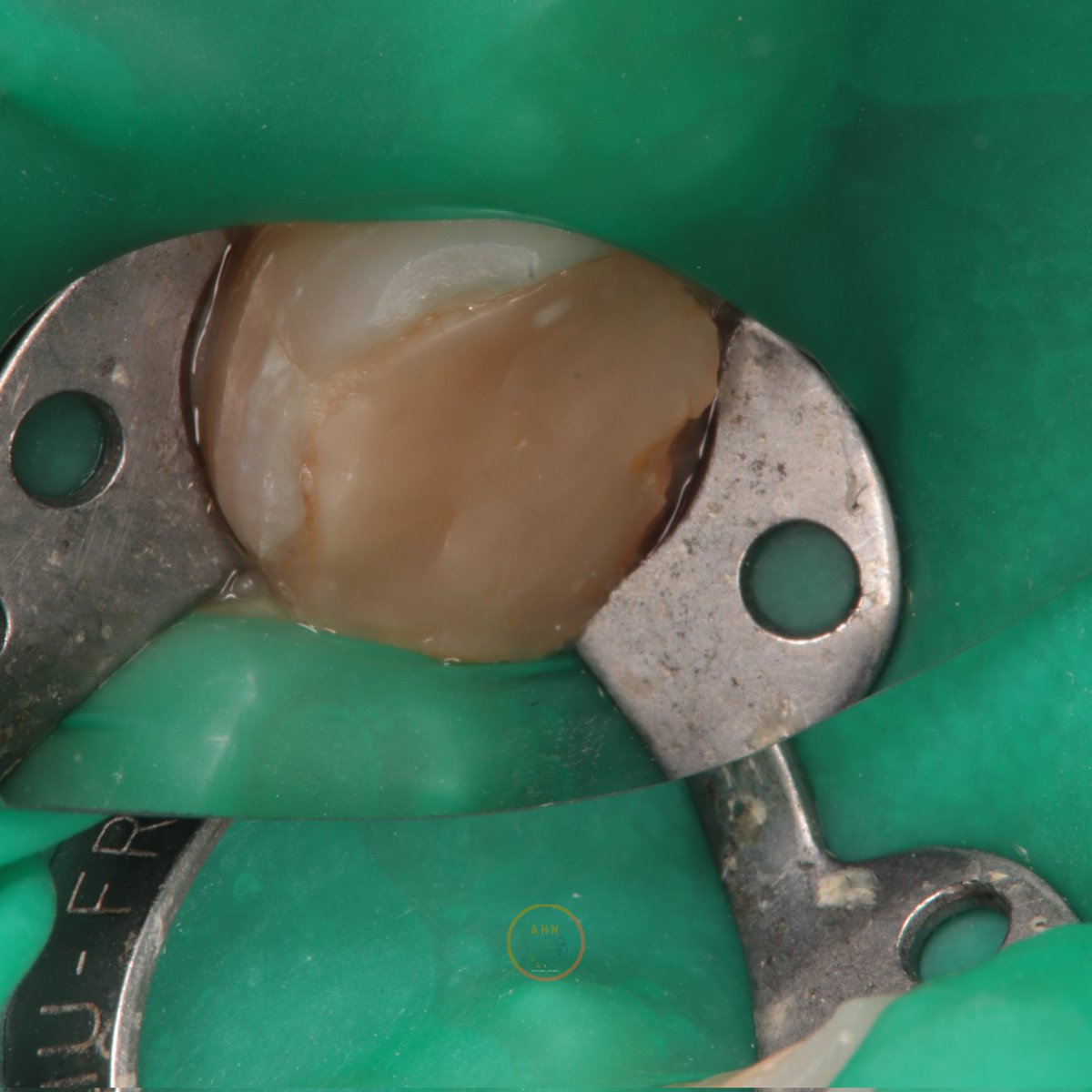 dentist_amar617's tweet image. تدعيم سن سفلي بدعامة فايبر  تجهيزا لعمل تلبيسة مستقبلا
Removal of old restoration of lower  1st molar #46 and plasing fiper post to prepare  the case for crowning 
#saveatooth  #ibracesclinics