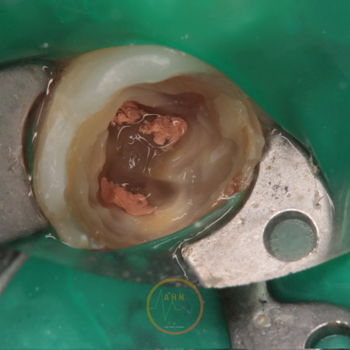 dentist_amar617's tweet image. تدعيم سن سفلي بدعامة فايبر  تجهيزا لعمل تلبيسة مستقبلا
Removal of old restoration of lower  1st molar #46 and plasing fiper post to prepare  the case for crowning 
#saveatooth  #ibracesclinics