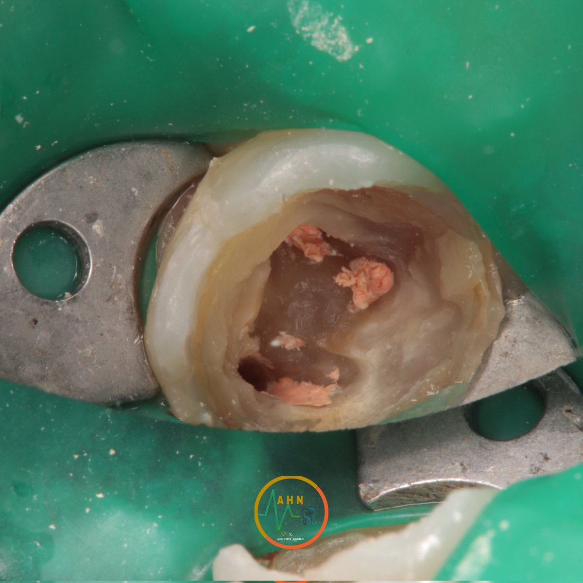 dentist_amar617's tweet image. تدعيم سن سفلي بدعامة فايبر  تجهيزا لعمل تلبيسة مستقبلا
Removal of old restoration of lower  1st molar #46 and plasing fiper post to prepare  the case for crowning 
#saveatooth  #ibracesclinics