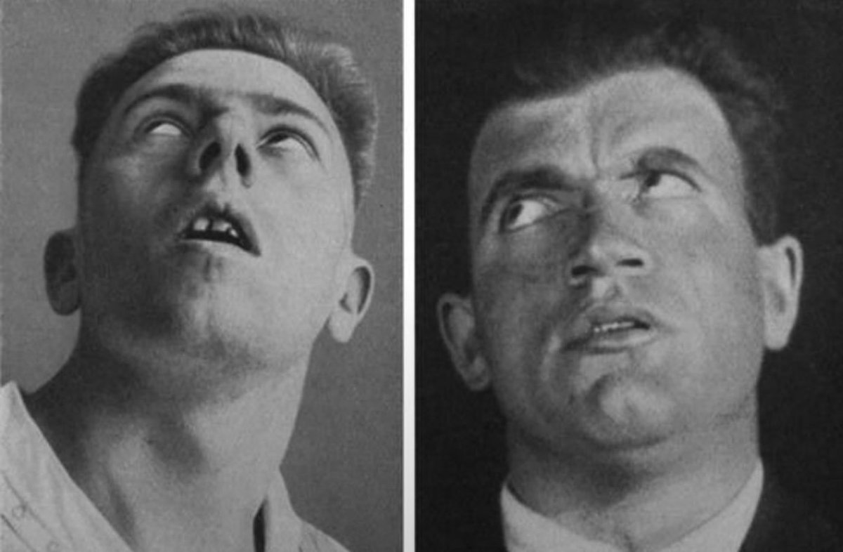 historyinmemes's tweet photo. Between 1916 and 1931, a strange illness known as encephalitis lethargica swept across the world, affecting millions.

Striking often after a sore throat or flu-like illness, it could leave victims in a deep, prolonged sleep that lasted weeks or months. Some collapsed mid-activity, food still in their mouths, while others suffered uncontrollable eye movements or developed symptoms similar to Parkinson's disease. Roughly a third of those infected perished, and many survivors were left with lasting disabilities or profound personality changes.

By the early 1930s, it faded as suddenly as it appeared, leaving scientists puzzled and the medical community to move on to other concerns. Modern analysis of preserved brain tissue has led most researchers to suspect an immune reaction to an infectious agent (possibly streptococcus or influenza) that damaged the brain's basal ganglia. Still, there is no certainty, and the mystery remains unsolved.