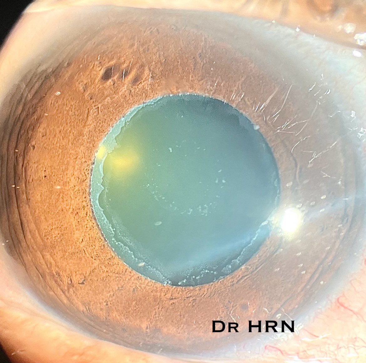 Pseudoexfoliation pearls:

1️⃣ Zonular weakness → use capsular tension ring

2️⃣ Common cause of secondary glaucoma

3️⃣ Iris transillumination at pupillary margin

4️⃣ Poor dilation → pupil devices

5️⃣ Bilateral but asymmetric

#Ophthalmology #Cataract