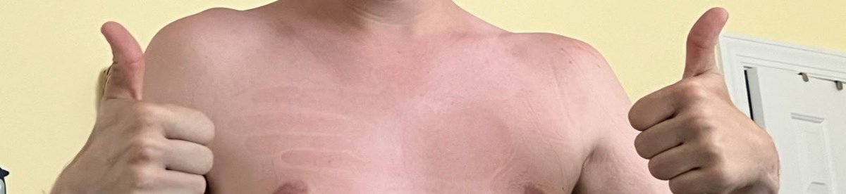 Flxmingoz's tweet photo. Woke up with my handprint on my chest with my burned chest ๐คฃ๐คฃ #freemynips https://t.co/RM3HPCuOZ9