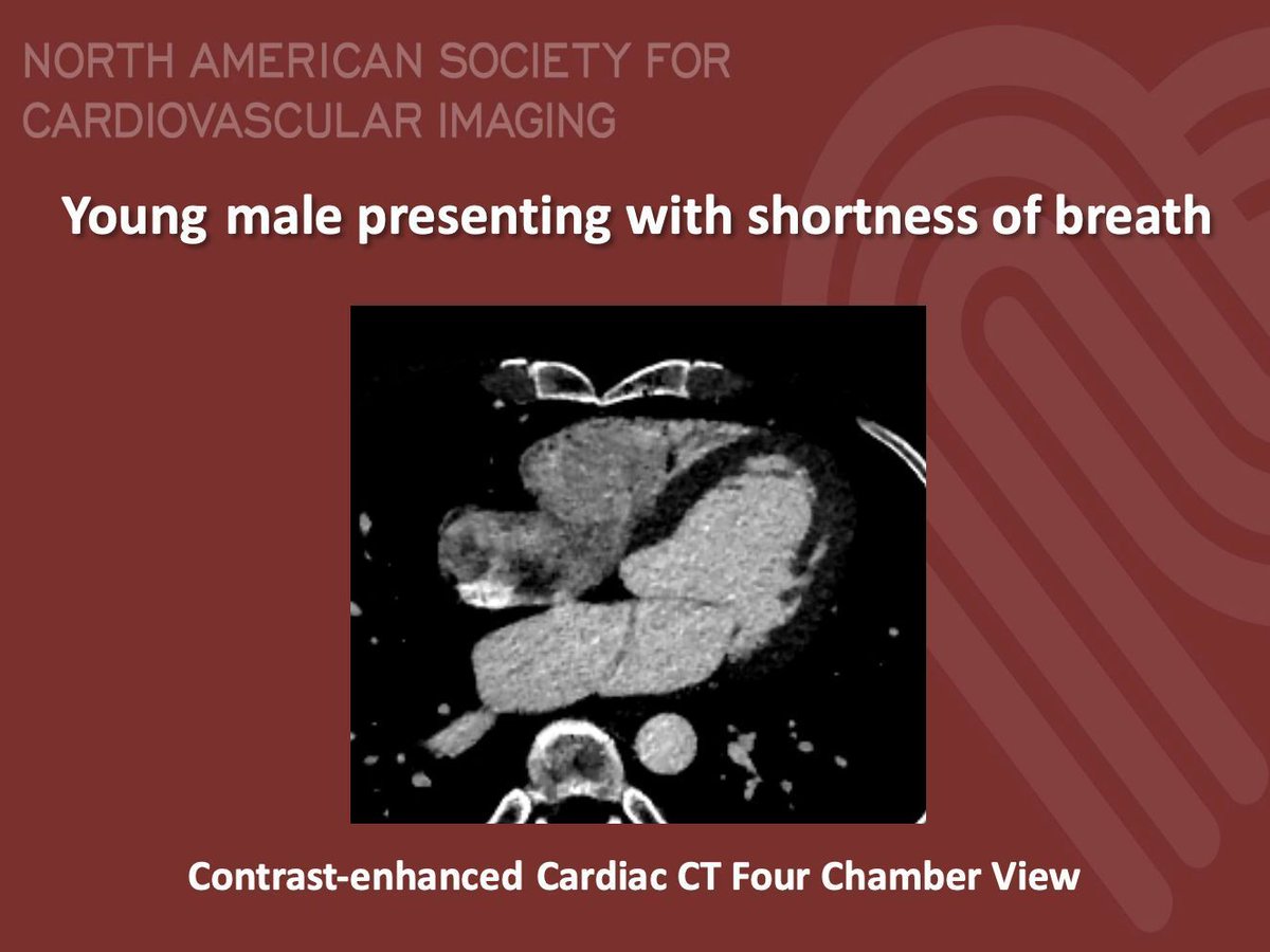 NASCI (@nascisociety) on Twitter photo #NASCI Case Series
Case 86
Courtesy of A. Batheja and S. Fadl from Virginia Commonwealth University School of Medicine
What is the right answer?
#whyCMR #YesCCT
<a href="/GregKicska/">Gregory Kicska</a> <a href="/JRevRad1/">Jonathan Revels DO, FSAR</a> <a href="/dianalitmano/">diana litmanovich</a> <a href="/DanielVargasMD/">Daniel Vargas, MD</a> <a href="/kirschj/">Jacobo Kirsch, MD, MBA, FACR</a> <a href="/prachipagarwal/">Prachi Agarwal</a> <a href="/EscrOffice/">ESCR Vienna</a> <a href="/DeCeccoCN/">Carlo N. De Cecco, MD, PhD</a> <a href="/CarlottaOnnis/">Carlotta Onnis</a> #NASCI Case Series
Case 86
Courtesy of A. Batheja and S. Fadl from Virginia Commonwealth University School of Medicine
What is the right answer?
#whyCMR #YesCCT
<a href="/GregKicska/">Gregory Kicska</a> <a href="/JRevRad1/">Jonathan Revels DO, FSAR</a> <a href="/dianalitmano/">diana litmanovich</a> <a href="/DanielVargasMD/">Daniel Vargas, MD</a> <a href="/kirschj/">Jacobo Kirsch, MD, MBA, FACR</a> <a href="/prachipagarwal/">Prachi Agarwal</a> <a href="/EscrOffice/">ESCR Vienna</a> <a href="/DeCeccoCN/">Carlo N. De Cecco, MD, PhD</a> <a href="/CarlottaOnnis/">Carlotta Onnis</a>