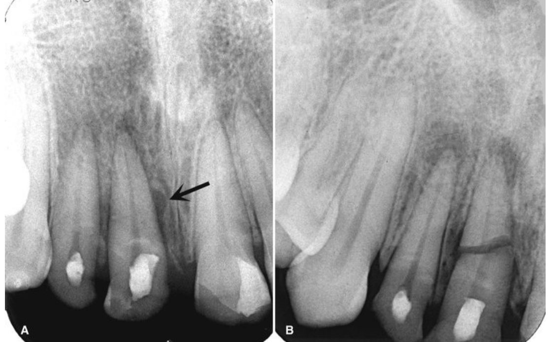 در برخی موارد که پلن شکستگی ریشه مشخص نیست، تنها نشانه شکستگی «افزایش عرض لوکالیزه pdl» مجاور ناحیه شکستگی است.

وایت‌فارو ۲۰۱۹