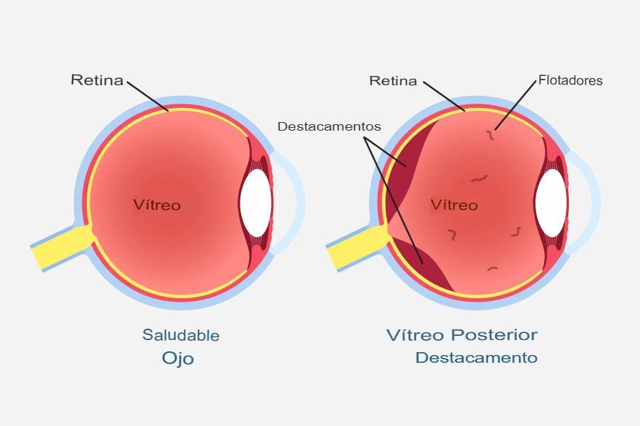 Las moscas volantes están arruinando tu visión.

¿Esas molestas motas y garabatos que flotan en tus ojos?

Esto es lo que realmente son, por qué los tienes y cómo DESHACERTE de ellos: