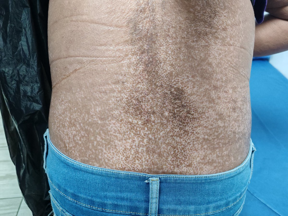 moy_qmac's tweet image. Bueno, ya le tiramos mucho hate a los reumas y traumas.

Veamos otro caso de diagnóstico tardio, solo recuerden que a todos se nos han ido casos así. 

Le toca a la especialidad clínica que mas detesto (por pura envidia de la mala); la dermatología.

Adjunto fotografía del caso.