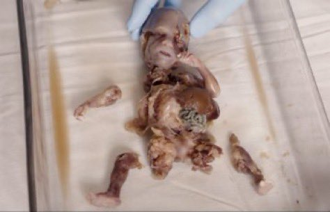 UniCatolicos_es's tweet photo. Negar la vida al que está por nacer nunca puede ser considerado un derecho humano.

El aborto es una atrocidad, es el genocidio más cruel de la historia. https://t.co/4vZDfsLom5
