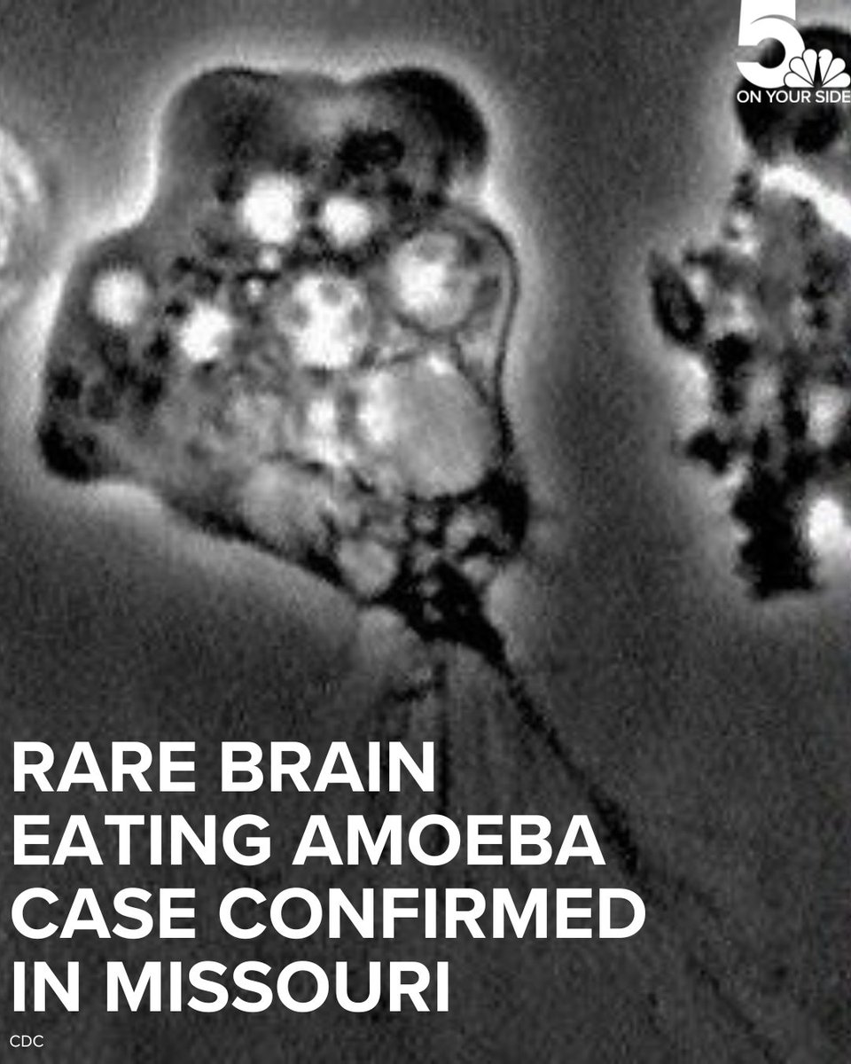 The patient was swimming at the Lake of the Ozarks just days before. Here's why scientists say the rare and deadly infection could become more common: ksdk.com/article/news/h…