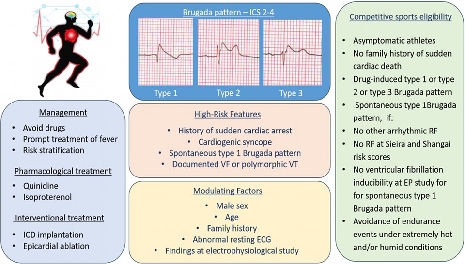 🔴Brugada Syndrome in Sports Cardiology:⤵️ A 2025 SICSport  Expert Opinion Statement  #OpenAccess 

🔹sciencedirect.com/science/articl… 
 #Cardiology #FOAMed #MedEd #medstudent #paramedic #Cardiology #CardioEd #medtwitter #meded #CardioTwitter #cardiotwiteros  #MedX #cardiovascular