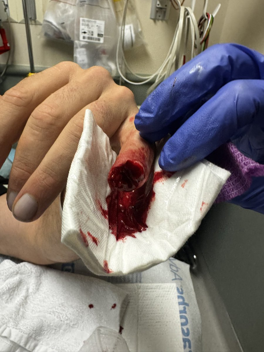 BradleyMartyn's tweet photo. For those wanting to see my finger. Before the surgery. https://t.co/XhG7n69fd1
