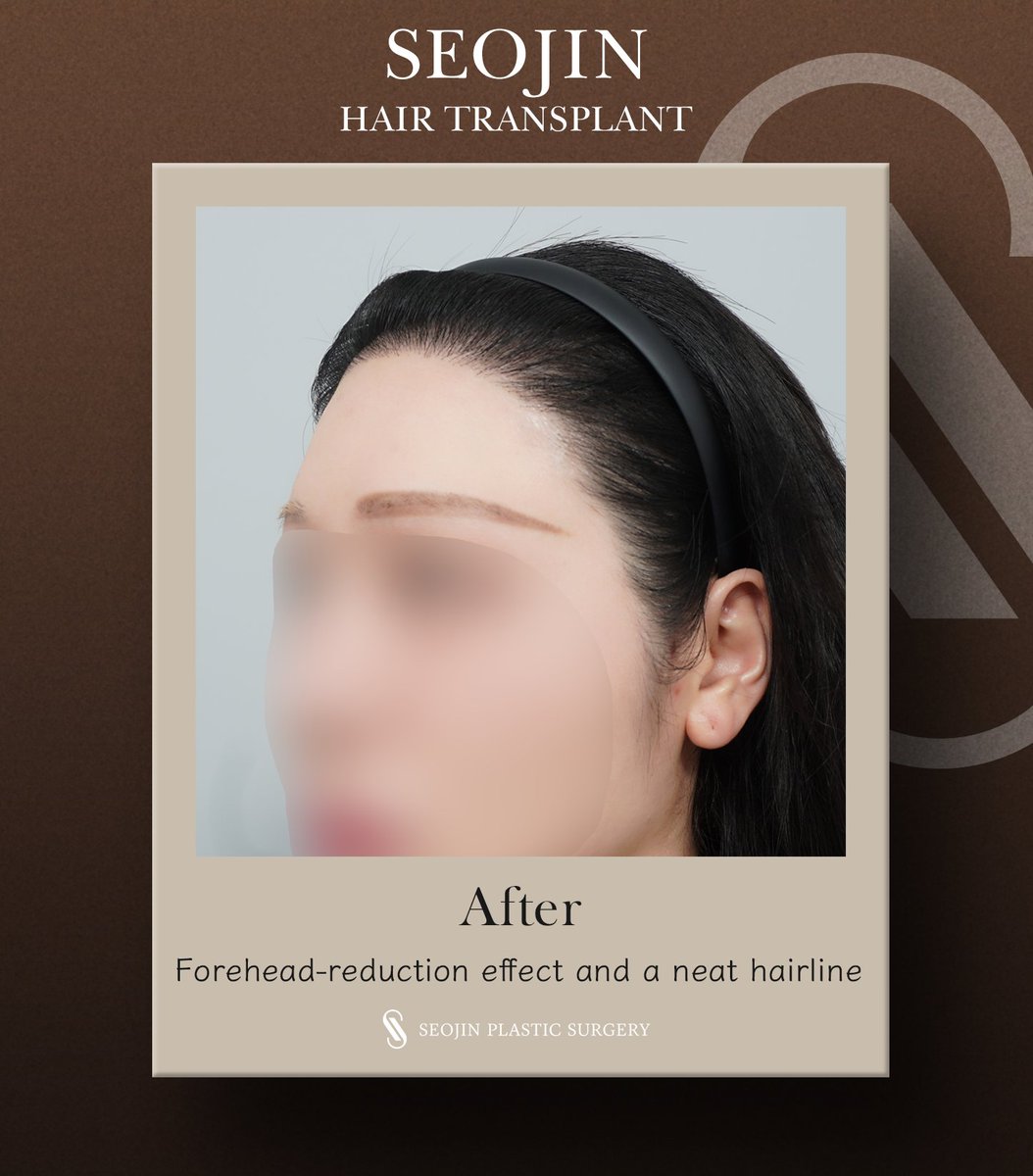 seojinps_eng's tweet photo. This patient came to Seojin after being disappointed with her forehead reduction surgery results 😢
After hair transplant, she is now more than thrilled with the results!
#HairTransplant #ForeheadReduction #HairlineCorrection #Hairloss #PlasticSurgeryKorea #Kbeauty #SeoulClinic https://t.co/U0l0ho4Z4X