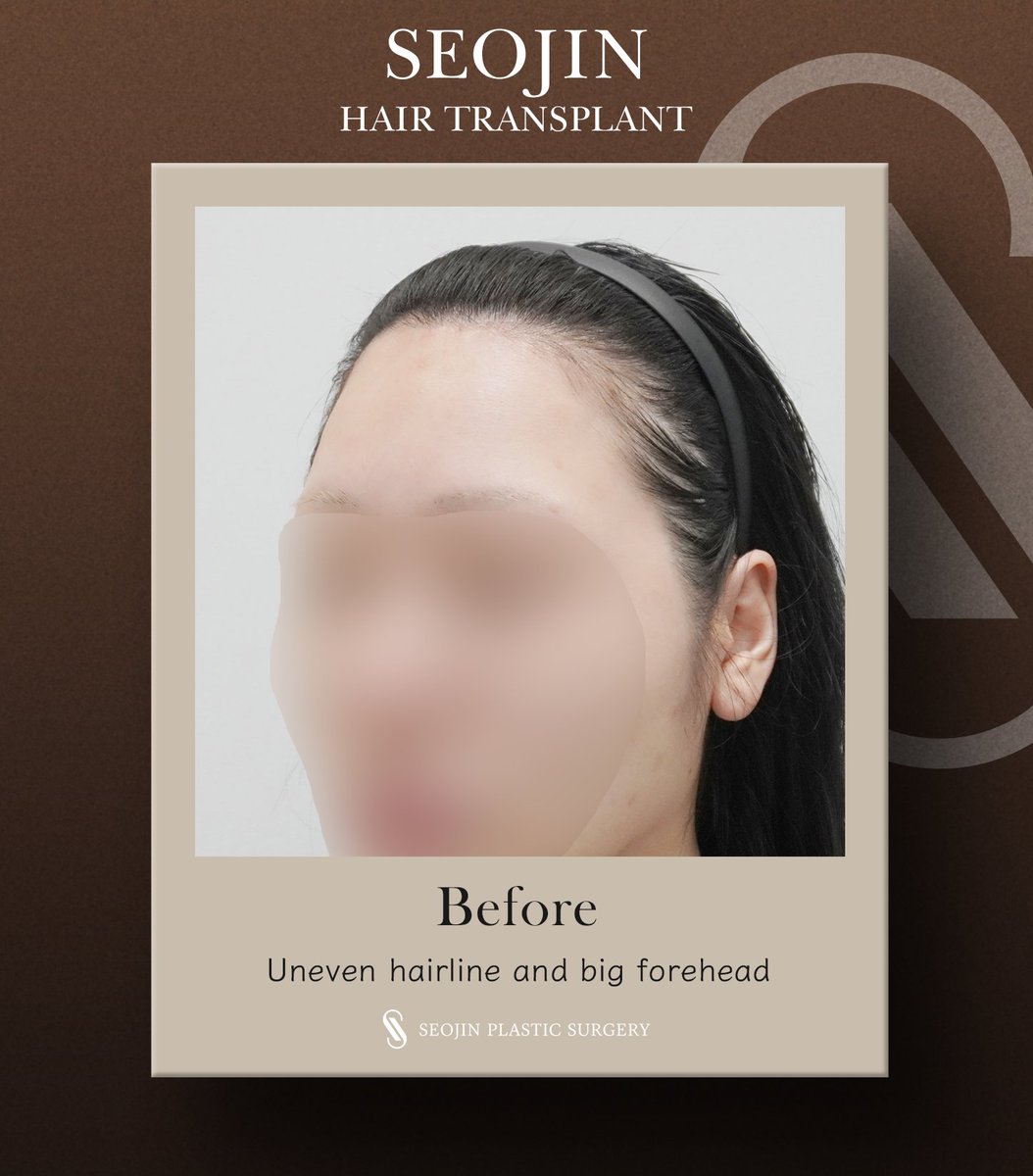 seojinps_eng's tweet photo. This patient came to Seojin after being disappointed with her forehead reduction surgery results 😢
After hair transplant, she is now more than thrilled with the results!
#HairTransplant #ForeheadReduction #HairlineCorrection #Hairloss #PlasticSurgeryKorea #Kbeauty #SeoulClinic https://t.co/U0l0ho4Z4X